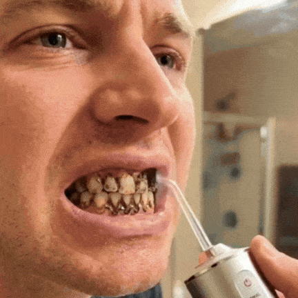 HydroBlast Pro in funzione per pulire i denti