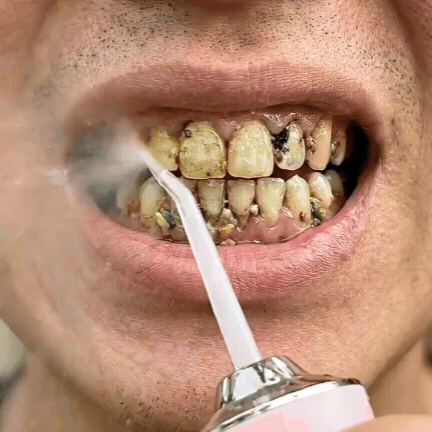 HydroBlast Pro rimuove residui tra i denti